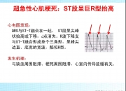 ST凯利获得发明专利授权：“一种多孔结构融合器”
