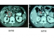 新放射疗法可有效减轻胰腺癌患者剧痛